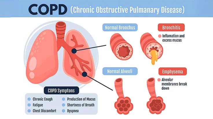 What is Chronic Obstructive Pulmonary Disease (COPD)?