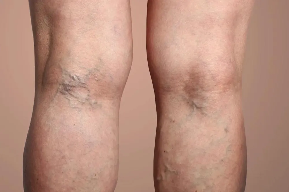 Varicose veins, Spider veins