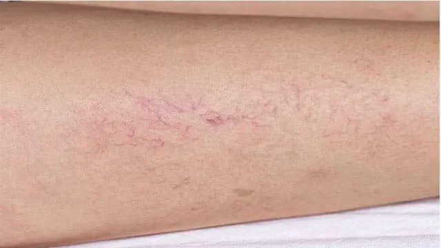 What is Chronic Venous Insufficiency?