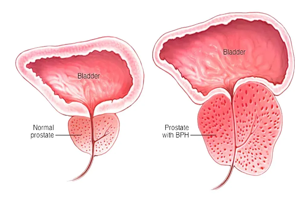 Prostate enlargement (BPH)