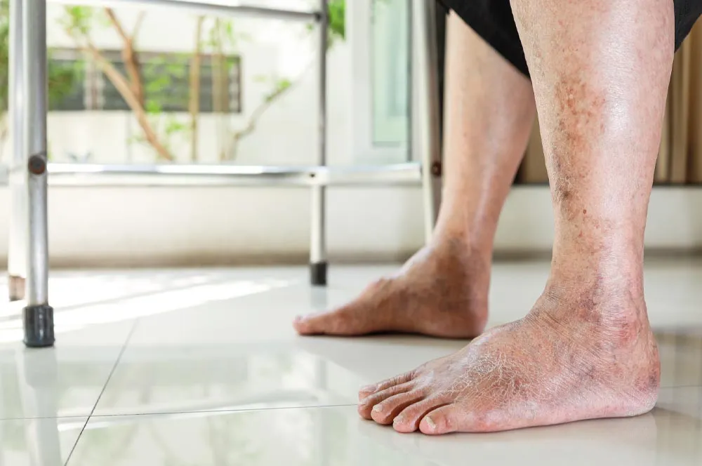 Peripheral arterial Disease