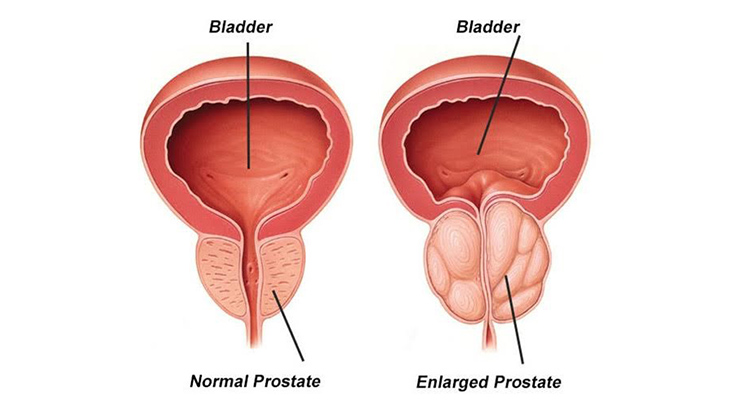 What Should You Know About Benign Prostate Enlargement?